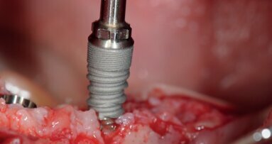 The clinical effects of insertion torque for implants placed in healed ridges: A two-year randomized controlled clinical trial