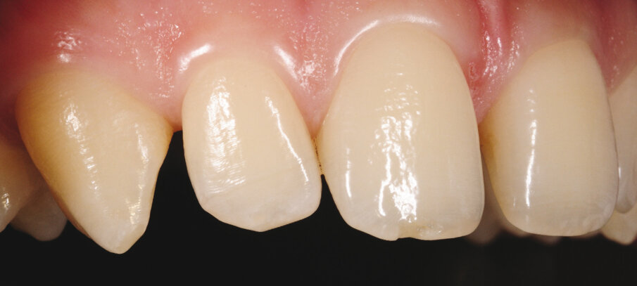 1a. i b. Usporedba zatvaranja interdentalnog razmaka na zubu 12 distalno i 22 mezijalno. 