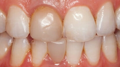 Fig. 1. Situación inicial: Tras el blanqueamiento preprotésico era apreciable una clara diferencia cromática entre la obturación de composite y la sustancia dental dura.