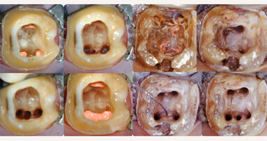 Back to the egg: An evidence-based endodontic implant algorithm