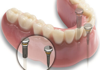 miniMARK Miniature Dental Implant System