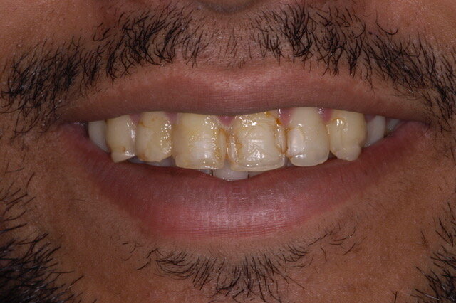 Fig 2A: Frontal smile view Before
