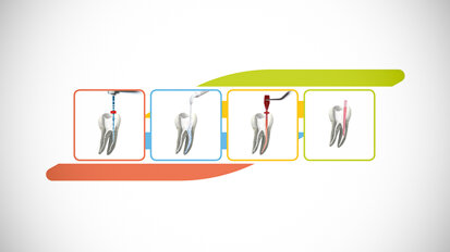 VDW Endo-System promises easy root canal therapy in four steps