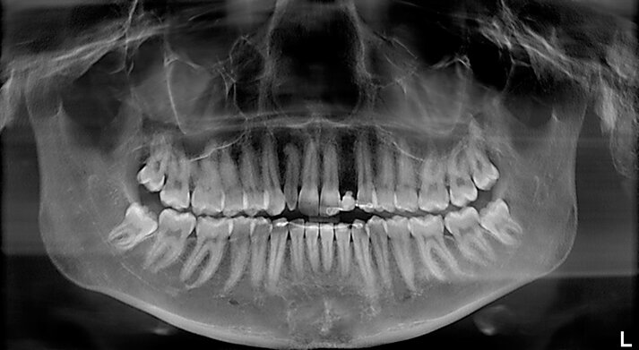 Fig. 1 - OPT delle arcate dentarie, si noti anomalia di forma elemento 12 e sito edentulo in sede 22.