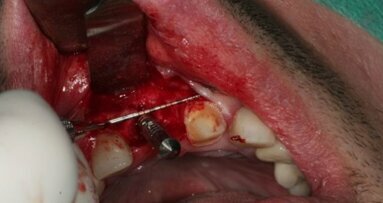 Leczenie implantoprotetyczne pojedynczych braków zębowych – opis przypadków