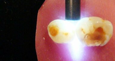 Laser é utilizado em pesquisa da FORP para prevenir cárie na raiz dos dentes