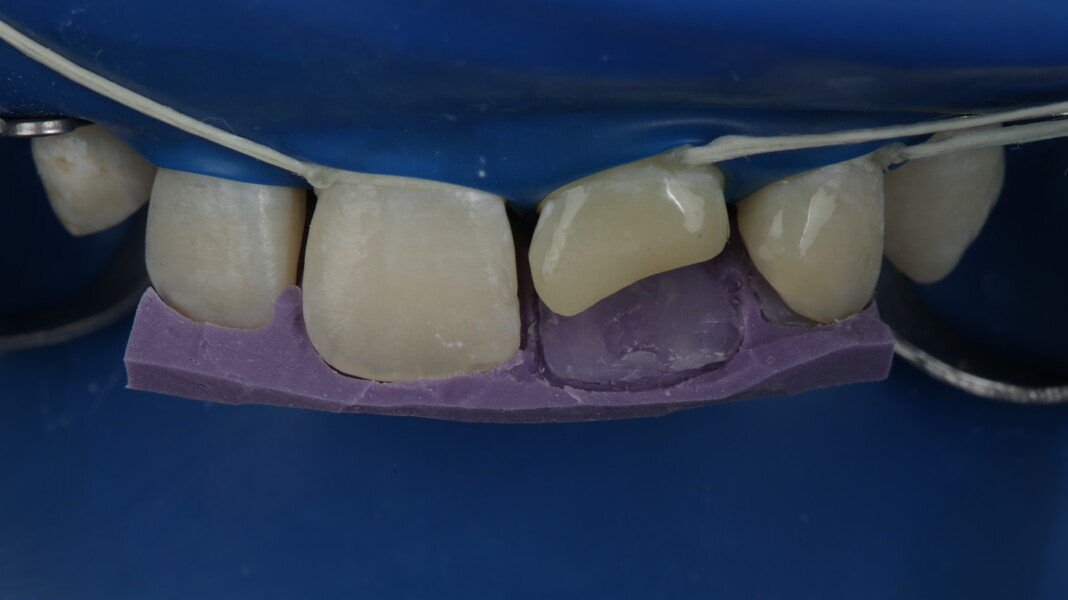 Fig 16: Clear translucent shade was used to build the palatal surface.
