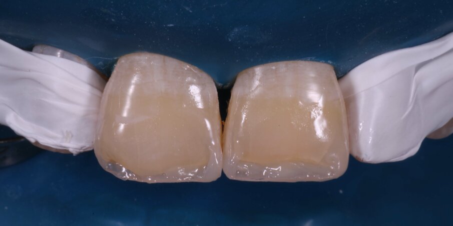 Fig 11: First layer of Dentin Shade Composite  