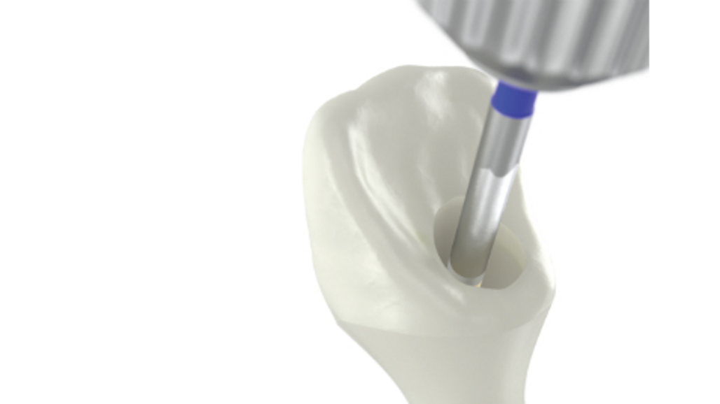 Nobel Biocare angulated screw channel solutions