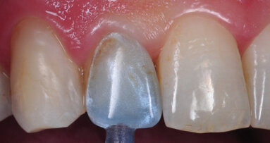 Restauration de dents antérieures « à emporter »