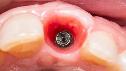 Experts agree on standards for clinical treatment of peri-implant soft tissue