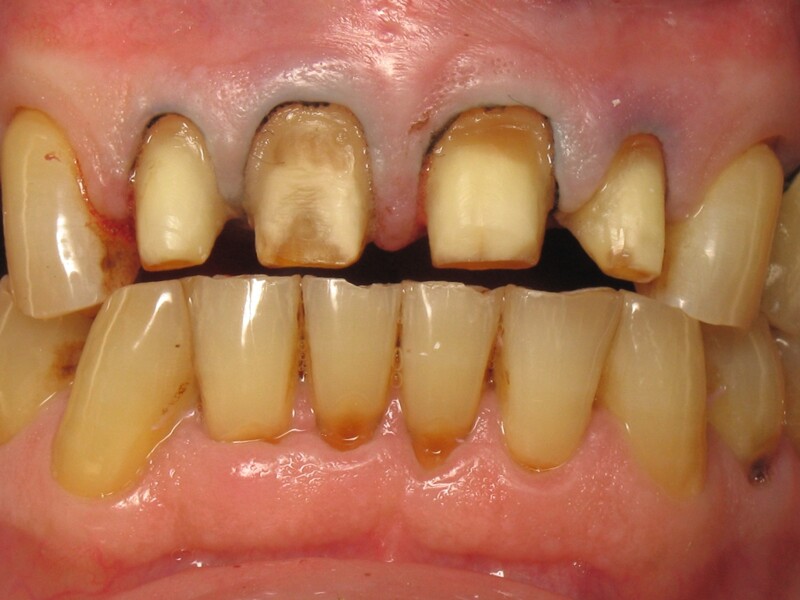 Fig. 8 : Préparation dentaire et rétraction gingivale.