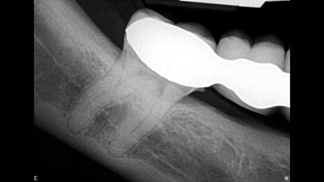 Fig. 12: Pre-op radiograph, showing the intimate relationship between the mandibular canal and the molar.