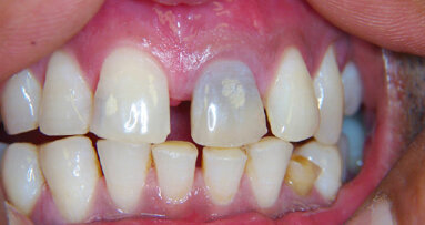 Vnitřní bělení horního  levého velkého řezáku: Jacob Krikor se podělil o své zkušenosti  s bělením zubů – řezáků