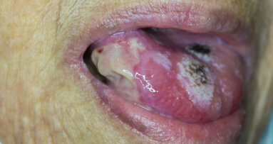 New guidance for care of patients with oral potentially malignant disorders