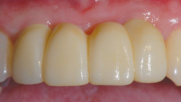 From intraoral scan to final custom implant restoration