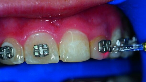 Le laser Er:YAG dans les phases de collage et de dépose des brackets lors du traitement orthodontique