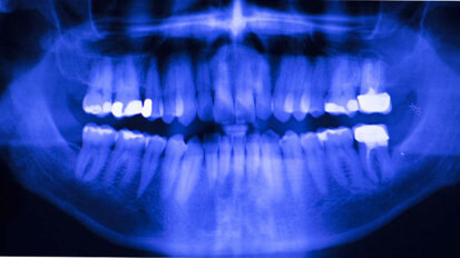 アマルガムからの脱却：歯科医師が適切な修復材料を選ぶための新しいオンラインツール