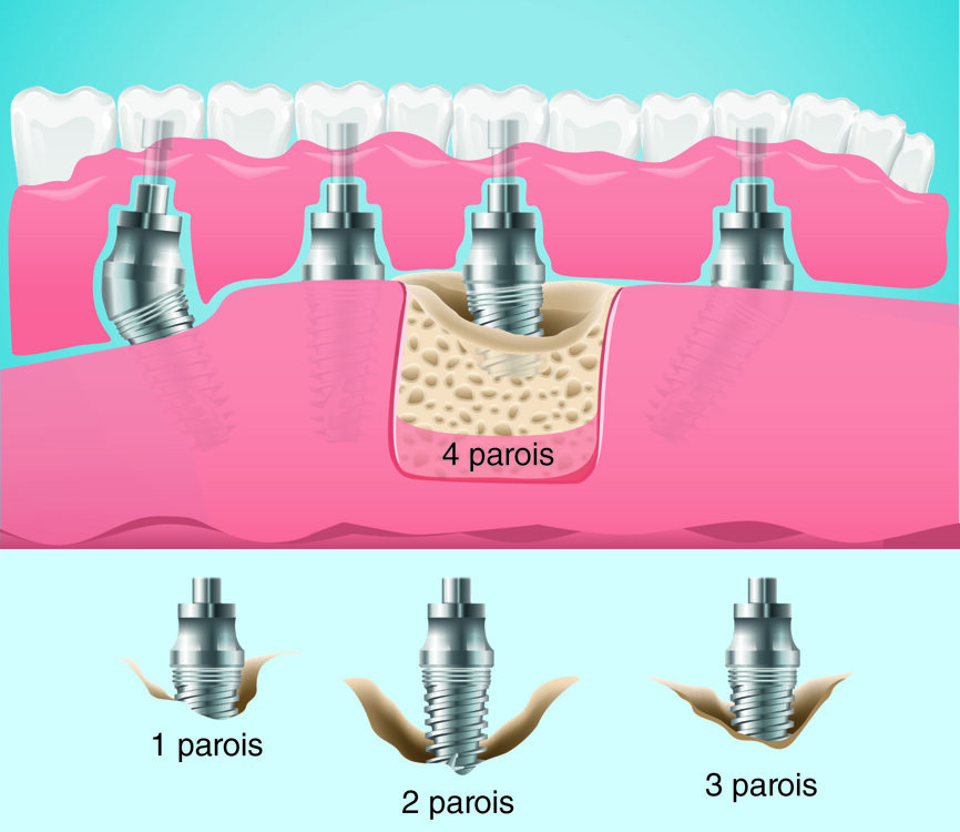 Fig. 4 : PA4b : Perte osseuse < 50 % de la hauteur implantaire, 1 à 4 Parois, avec ou sans cratère.