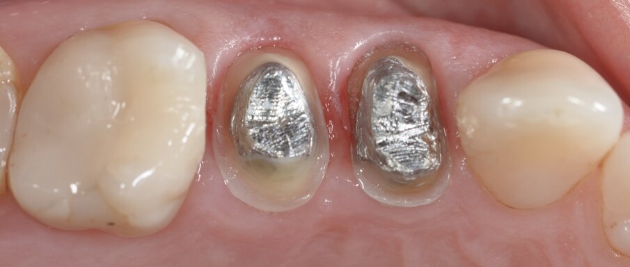 Fig. 3: Denti preparati per l’impronta digitale.