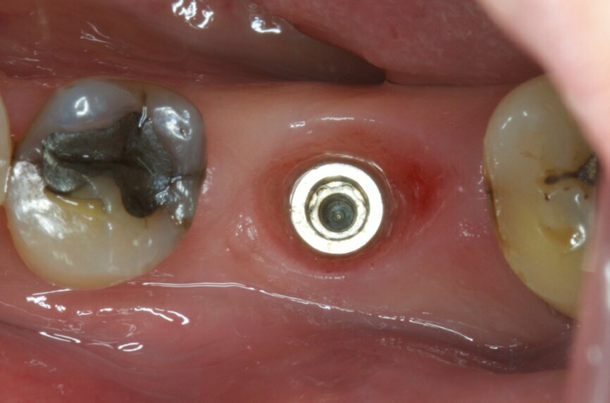 Fig. 21: Gingival healing ready for initiation of definitive crown.