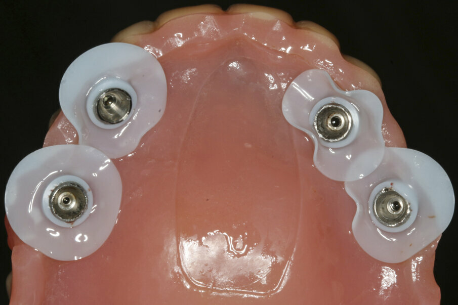 Fig. 10: Intra-oral gluing of the temporary cylinders to the existing denture.