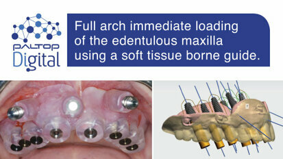 Full arch immediate loading of the edentulous maxilla using a soft tissue borne guide.