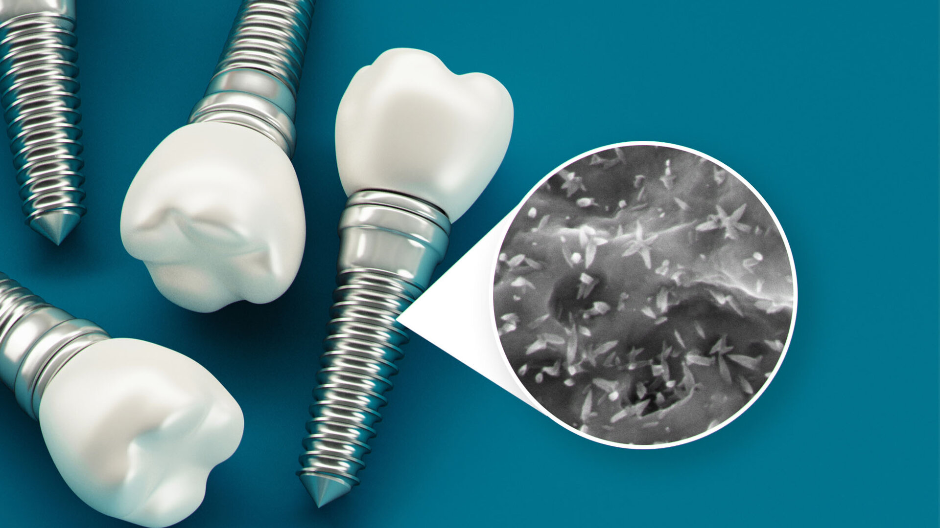 Dentistry at nanoscale: how nanotechnology advances the properties of dental implant surfaces
