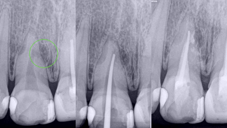 Figs. 6a–c: Radiographic sequence of the treatment performed in tooth #11. Initial radiograph. The root resorption and lateral radiolucent area were evident (a). Working length measurement at the level of the resorption (b). Root resorption repair with a calcium silicate-based material (c).