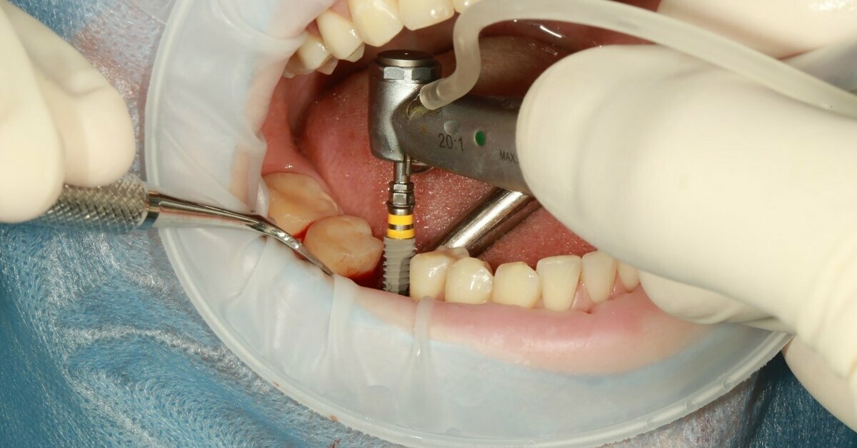 Review study compares machined and sandblasted dental implant surfaces