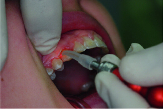 Surgical laser-assisted treatment via laser gingivectomy.