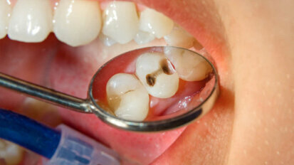 Lidský imunitní systém přispívá k zubnímu kazu a poškození zubních výplní