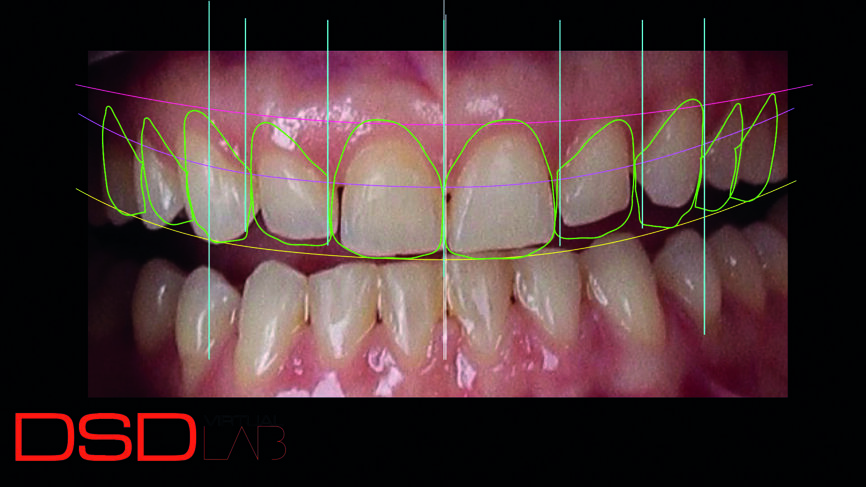 Fig. 3 : Conception numérique du sourire montrant l‘élongation coronaire des dents 13, 12, 11 et 21 ainsi que le traitement de restauration des dix dents antérieures.