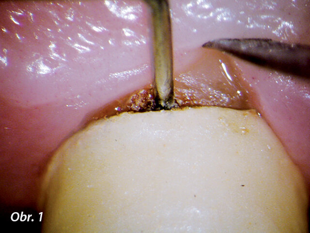 Vyšetření kazu pod okrajem korunky při vysokém zvětšení (zveřejněno se svolením Dr. Francesca Maggiorea, Aschaffenburg, Německo).  (Fotografii poskytla Americká asociace endodontistů)