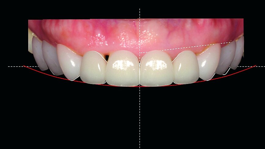 Fig. 9: DSD dentition view pre operation.