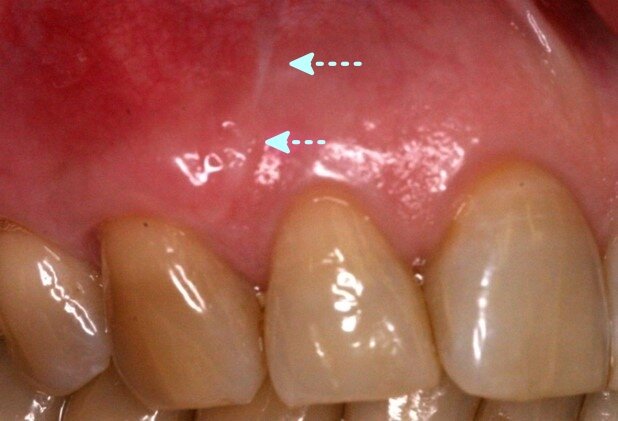 Fig. 6: Vertical release incisions in esthetic zone can often lead to scar tissue visible even 7 years post-op
