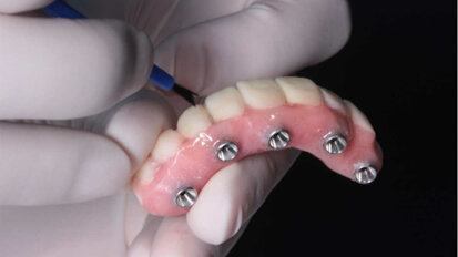 Review recomenda próteses dentárias fixas suportadas por dente e implante