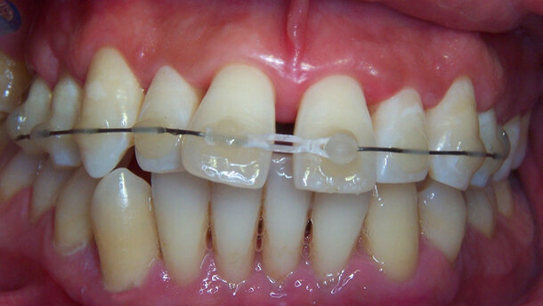 L'orthodontie sans attaches fixes