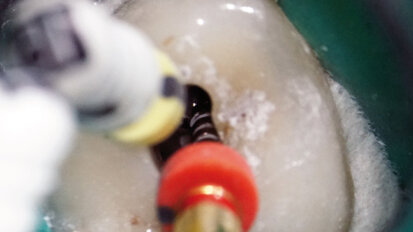 Endodontické ošetření – případová studie