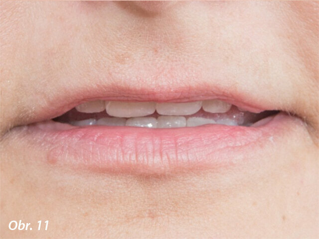 Finální vzhled s uvolněným rtem ukazuje správný poměr zubních struktur