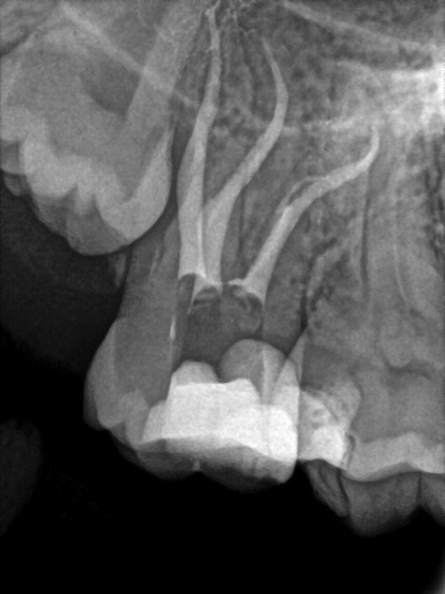 Fig. 28: Periapical radiograph showing the result after obturation. Note the evidence of an additional canal loop in the mid-root area on the mesiobuccal root canal system that was obturated.