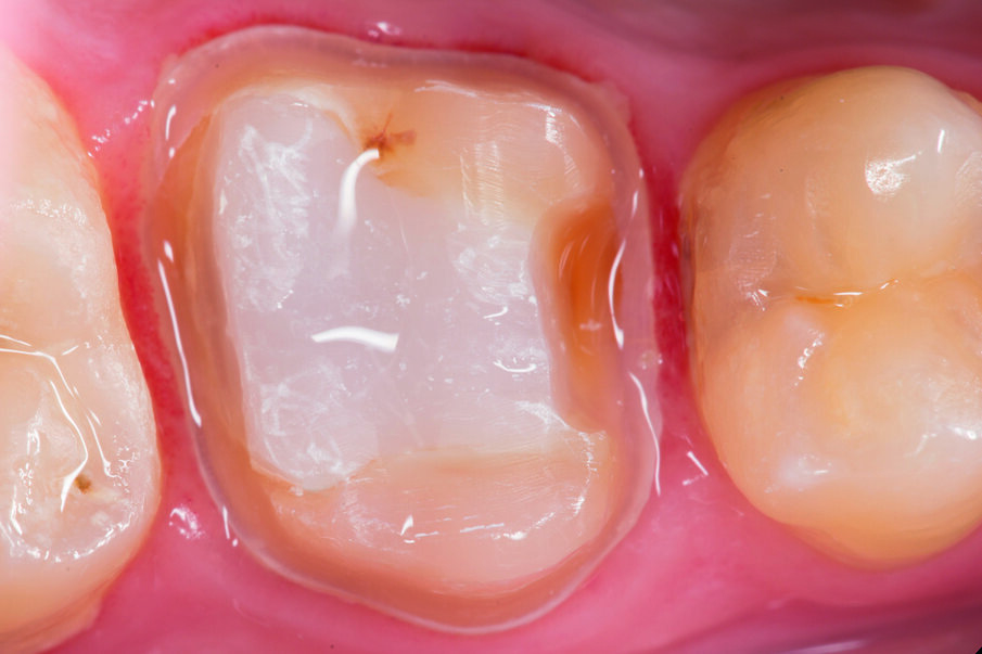 Fig. 6: View of the tooth – with the SDR® Plus core prepared for crown seating.. 