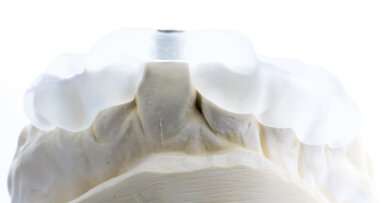 Navigovaný endodontický přístup u kalcifikovaných frontálních zubů: Kazuistika