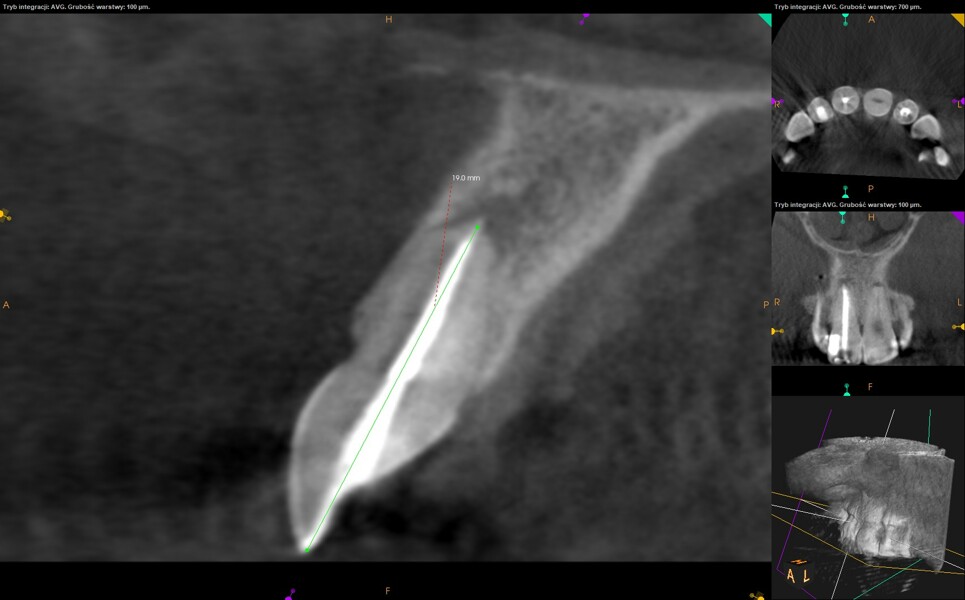 Fig. 13: CBCT check, sagittal plane. The long axis of the root and the axis of the access cavity and root canal preparation were visible.