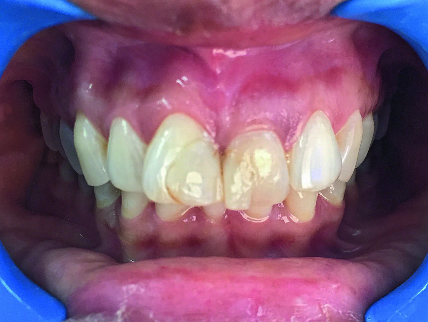 Fig. 1a : Photographie clinique préopératoire de la dent 21.