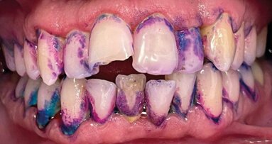 Efficacia di un dentifricio bioadesivo sui tessuti parodontali: uno studio prospettico su soggetti “special needs”