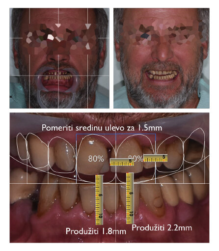 Kolaž slika 1: Prikaz komunikacije u smislu početne situacije, plana tj. željenog izgleda, odnosa, proporcija i na kraju izbrušenih zuba (U saradnji sa dr spec. stomatološke protetike Srđanom Konatarom, Specijalistička stomatološka ordinacija Dentalux)