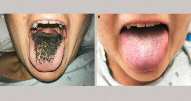 Rare case of black hairy tongue reported