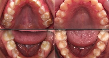 El Sistema Myobrace o la evolución en ortodoncia