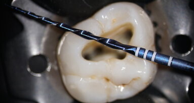 A personal experience of RECIPROC blue in endodontic practice